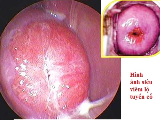 điều trị viêm lộ tuyến cổ tử cung