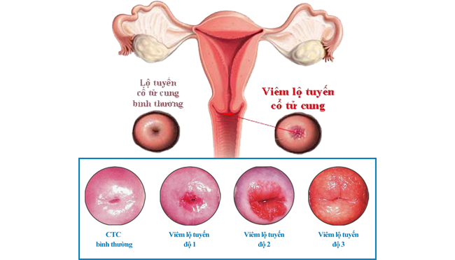 Hình ảnh về viêm lộ tuyến cổ tử cung 2