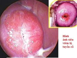 Hình ảnh về viêm lộ tuyến cổ tử cung 4