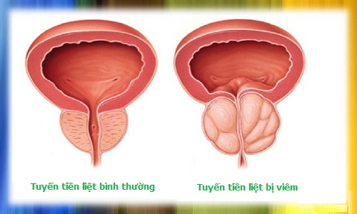 Khám viêm tuyến tiền liệt ở đâu chính xác nhất tại Hà Nội 1